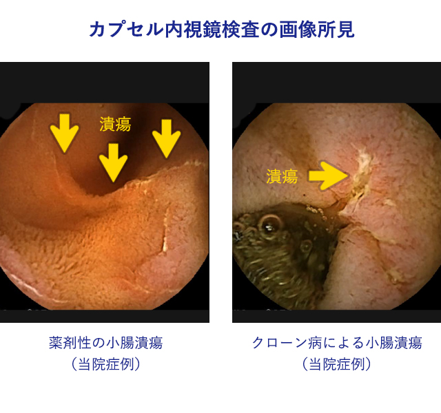 内視鏡検査