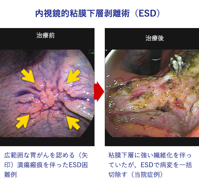 内視鏡的消化管ステント留置術