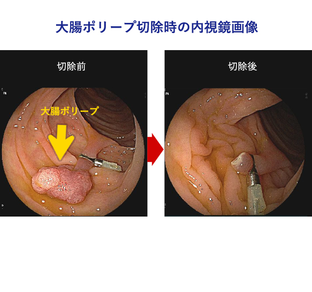 日帰り大腸ポリープ切除術