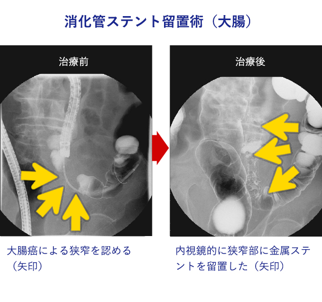 内視鏡的消化管ステント留置術