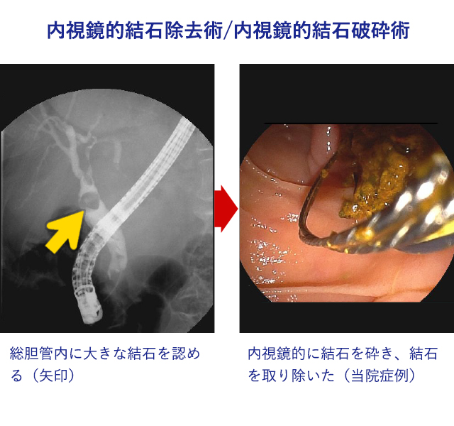 内視鏡的結石除去術／内視鏡的結石破砕術