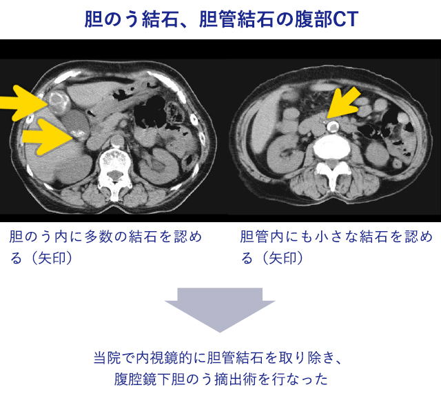 胆石症